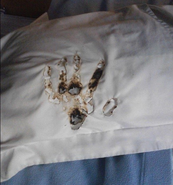 Stan_Romanek_handprints_burned_into_pillowcase_during_meditation